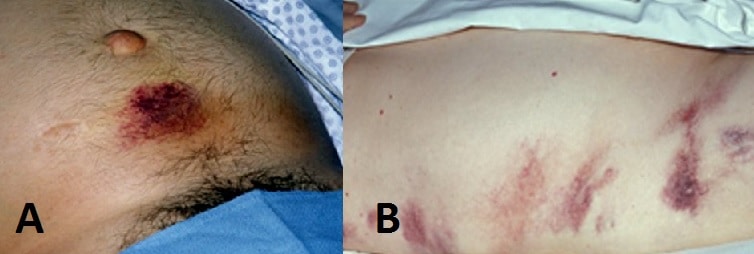 Fig 1 - Clinical Signs of Retroperitoneal Haemorhhage, as seen in acute pancreatitis (A) Cullen's Sign (B) Grey-Turner's Sign