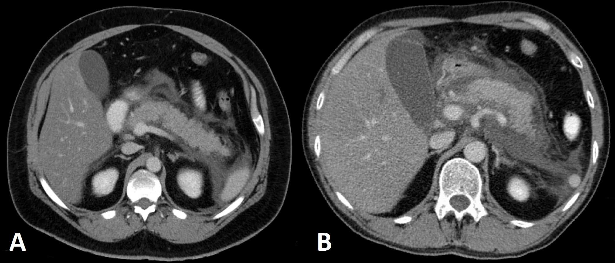 Fig 2 - Pancreatitis on Axial CT Scan (A) Localised oedema around the pancreas (B) Extensive fluid collections around the pancreas