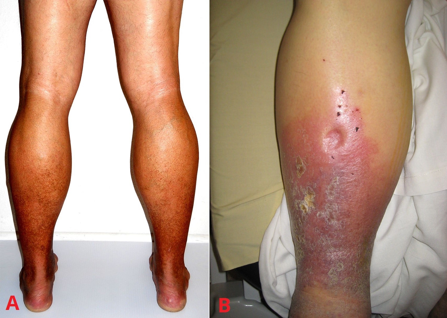 Fig 2 - Skin changes associated with venous insufficiency. A - hyperpigmentation of the limbs. B - pitting oedema and lipodermatosclerosis.