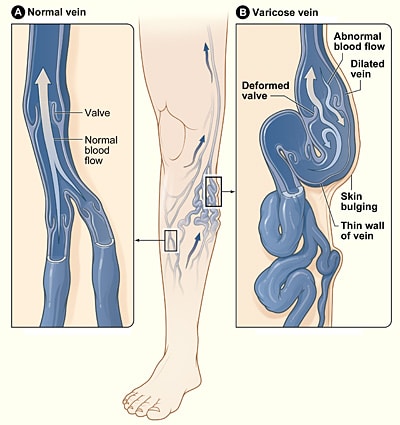 Vulvar Varicosities: Causes, Symptoms, Diagnosis & Treatment