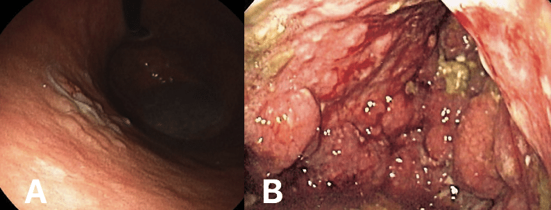 Fig. 3 - (A) Early stage gastric cancer (B) Linitis Plastica, whereby the malignancy has invaded most of the stomach and produced a 'leather-bottle' type appearance