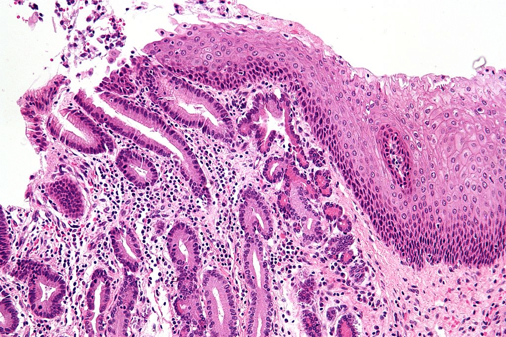 Fig 1 - Barrett's oesophagus at the GOJ, showing gastric acinar metaplasia on the left and oesophageal stratified squamous epithelium on the right