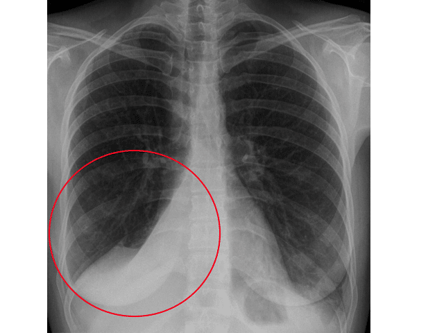 Fig 2 - Chest x-ray, demonstrating atelectasis in the patient's right lower lobe