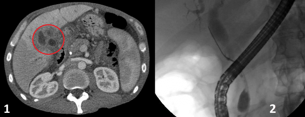 Fig 2 - Imaging for Cholangiocarcinoma. (1) CT scan showing cholangiocarcinoma (circled) (2) ERCP showing common bile duct stricture and dilatation of the proximal duct