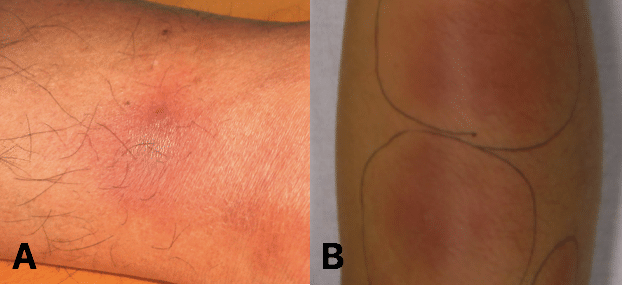 Fig 2 - Erythema nodosum is a relatively common extra-intestinal feature of ulcerative colitis.