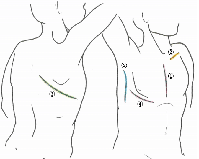 Fig 1 - Common cardiothoracic incisions. ① Midline sternotomy, ② Pacemaker scar, ③ Posterolateral thoracotomy, ④ Anterolateral thoracotomy, ⑤ Axillary thoracotomy