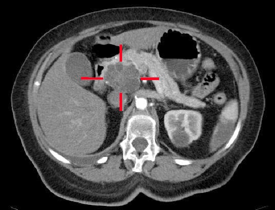 Fig 2 - A adenocarcinoma located in the pancreatic head, identified on CT scan