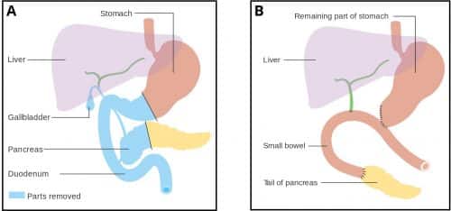 Fig 3 - Pancreaticoduodenectomy (Whipple's procedure). A: Pre-procedure, B: Post-procedure.