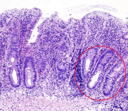Fig. 1 – Histology of Bowel Segment in UC, showing non-granulomatous inflammation with crypt abscess (circled) formation
