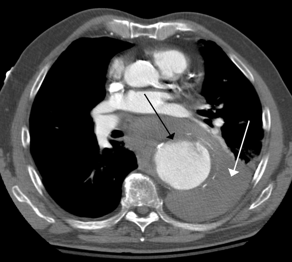 Fig 3 - Contrast CT scan demonstrating a 7cm thoracic aortic aneurysm (black arrow), which has ruptured. The white arrow demonstrates blood in the thorax.