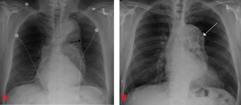 Fig 2 - X-ray of a thoracic aortic aneurysm. A - Arrow marks the lateral border of the aorta. B - after endovascular repair.