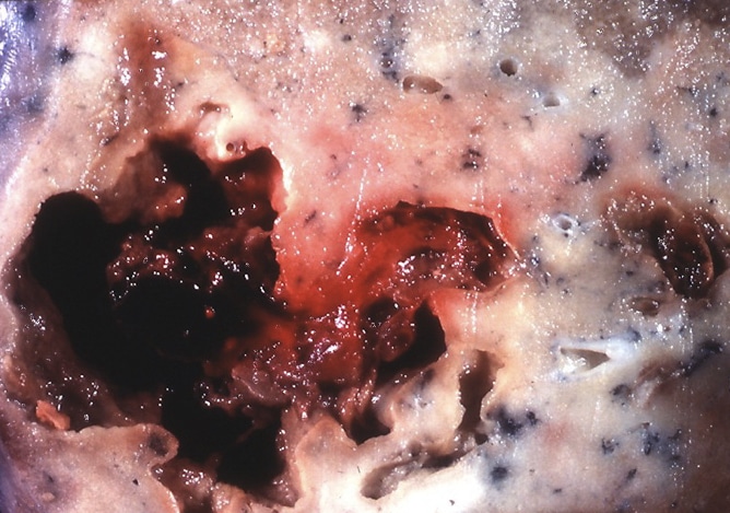 Fig 3 - Remnant of a drained pulmonary abscess at post-mortem