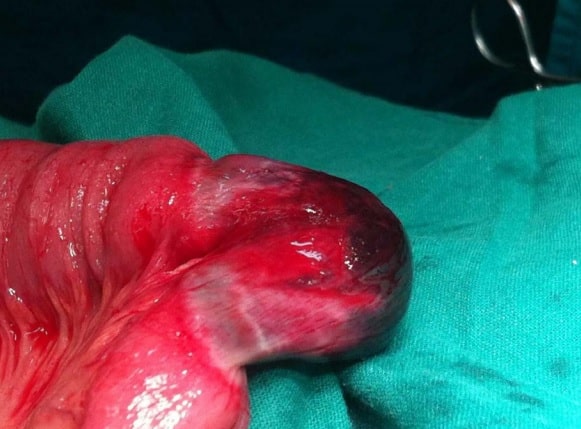 Intraop photograph of the large femoral hernia sac