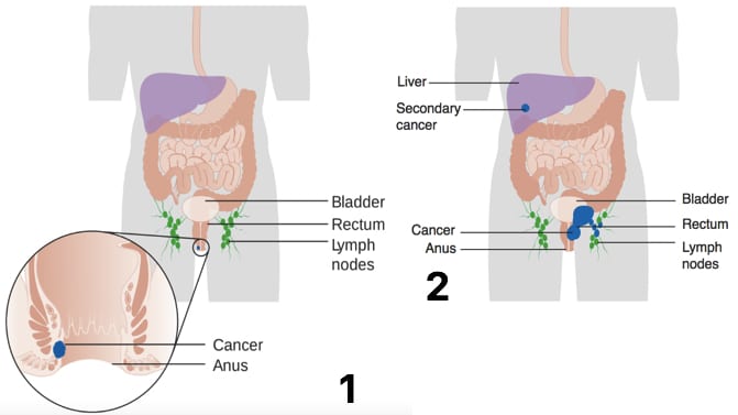 Fig. 2 - Diagram showing the (1) Stage 1 and (2) Stage 4 anal cancer metastasis