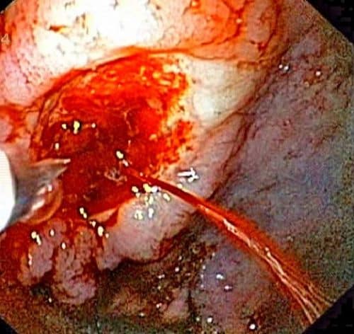Fig 1 - Endoscopic image of a bleeding gastric ulcer. This requires urgent surgical intervention.