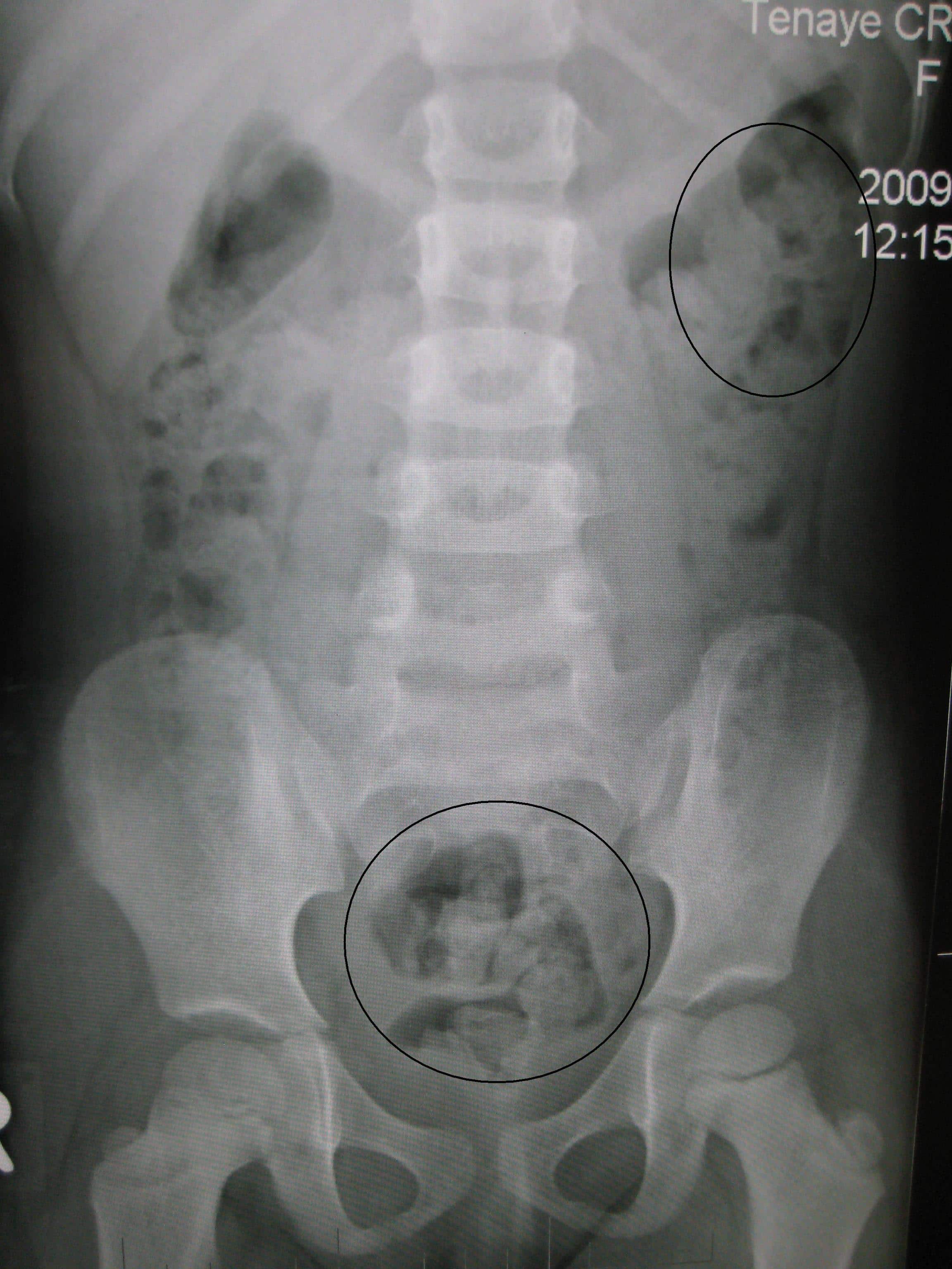 Post-Operative Ileus - TeachMeSurgery