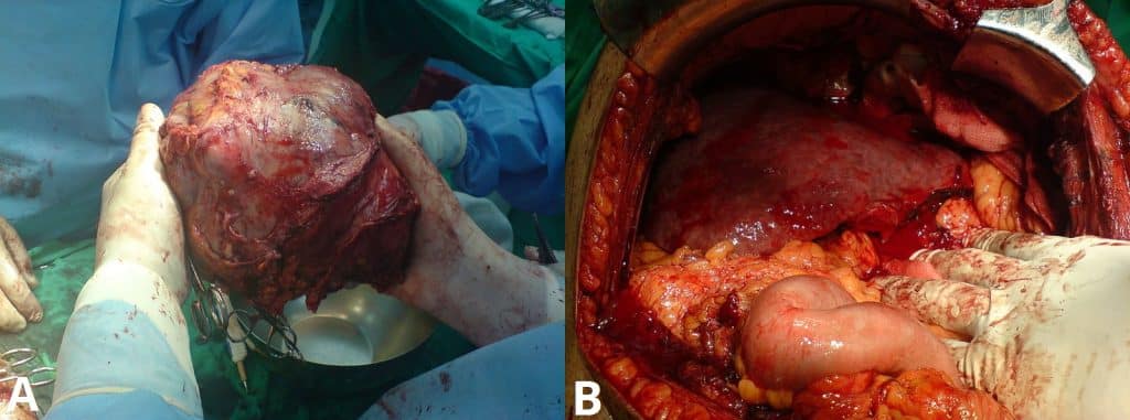 Fig 3 - Left lobe liver tumour in a 50 year old male. A) Removal of the tumour; B) The liver after resection.