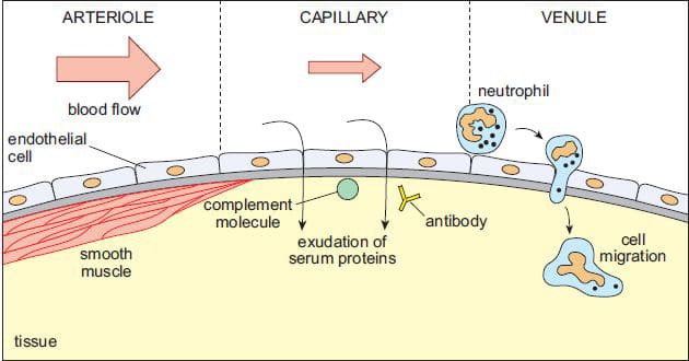 Fig 2 - The features of acute inflammation; vessel vasodilation, exudate formation and neutrophil migration.
