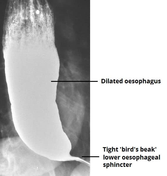 Fig 2 - The characteristic feature of achalasia on barium swallow; a bird's beak appearance caused by failure of relaxation of the lower oesophageal sphincter