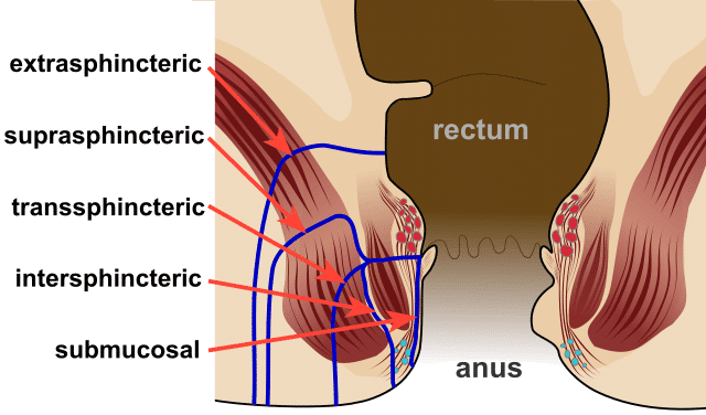 fistula symptoms