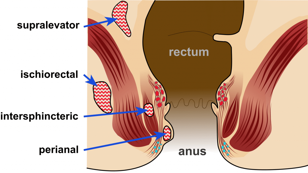 Cyst between scrotum and anus