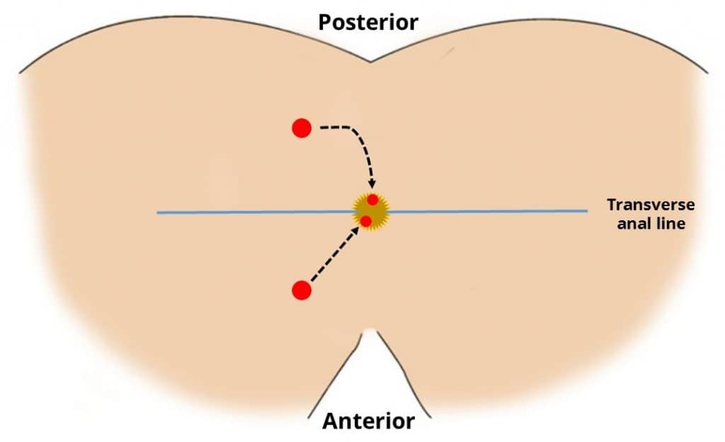 fistula pe penis)