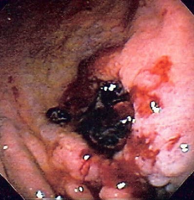 Fig 3 - A gastric malignancy, first presenting with melaena