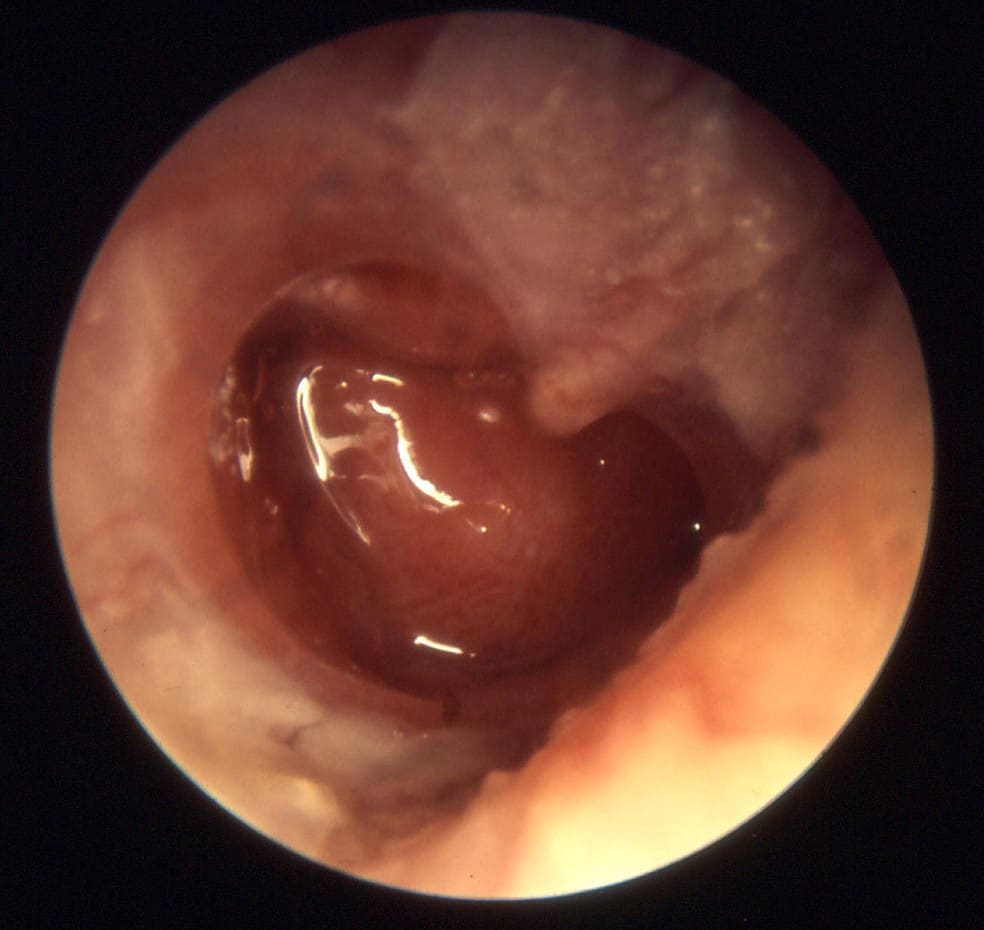 Appearance of chronic otitis media on otoscopy. A large tympanic membrane perforation is visible.