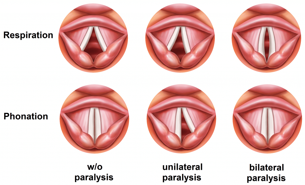 Causes For Raspy Voice Ukrainedeal