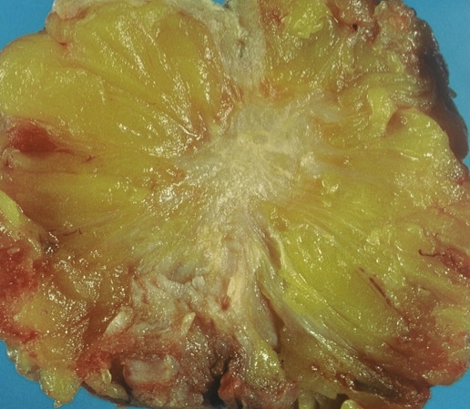 Macroscopic appearance of breast carcinoma (following complete mastectomy).