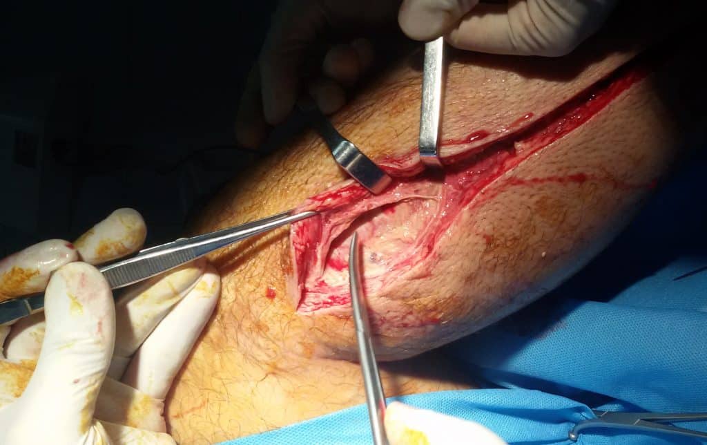 Compartment Syndrome - Clinical Features - Emergency Management -  TeachMeSurgery