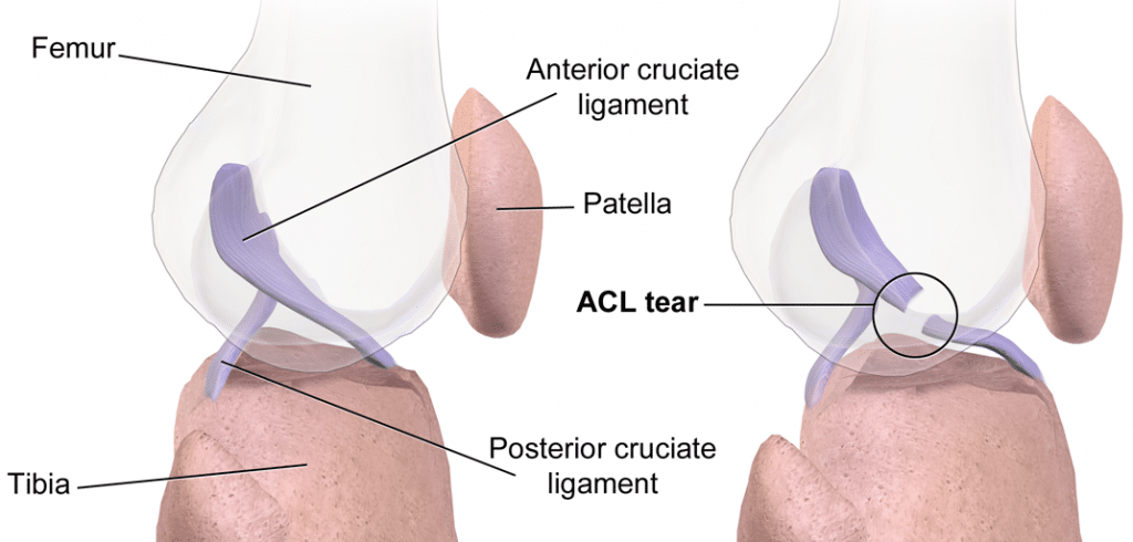 Anterior Cruciate Ligament Tear - MRI - Surgical Repair - TeachMeSurgery