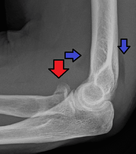 non displaced radial head fracture