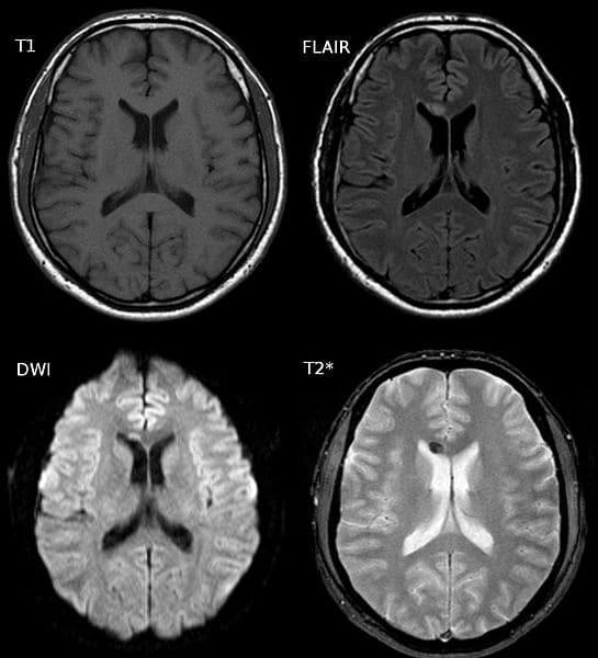 Diffuse Axonal Injuries Of The Brain Often Result In - mapasgmaes