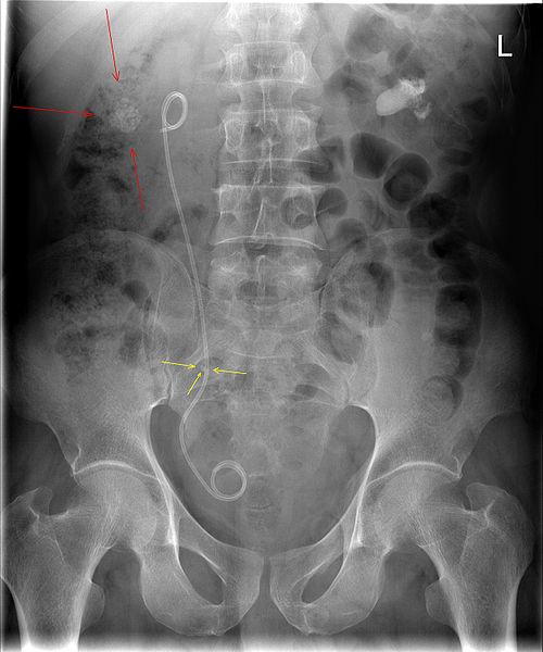 nephrolithiasis x ray
