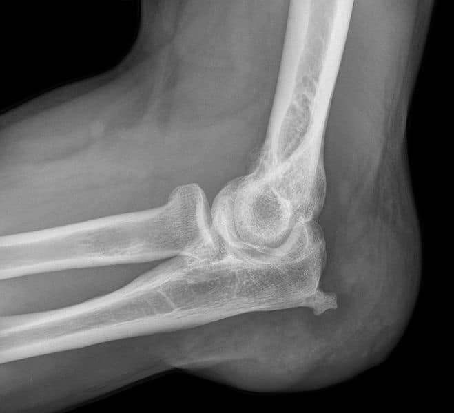 Olecranon Bursectomy