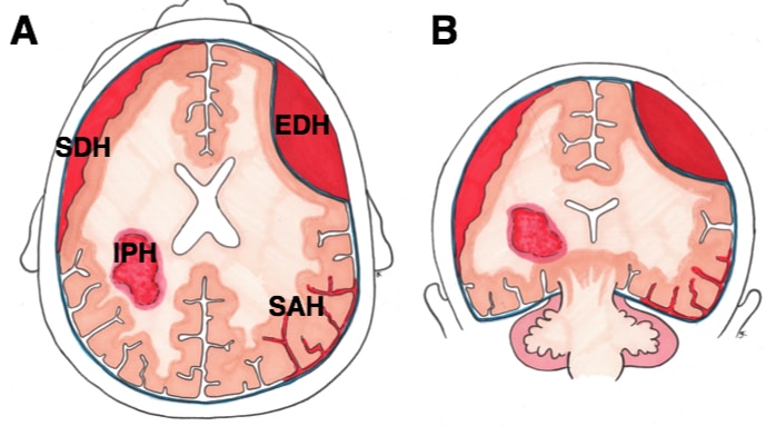 intracerebral hemorrhage locations