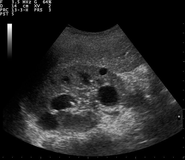 ultrasound images of kidney mass
