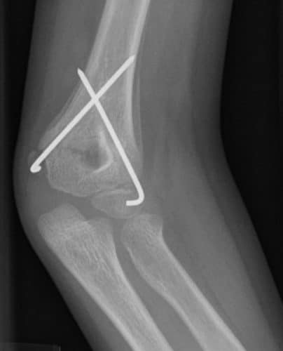 supracondylar fracture right elbow icd 10