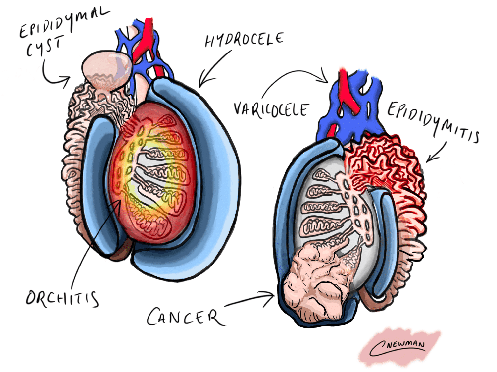 testicular-cancer-symptoms-signs-of-testicle-tumour-include-lump