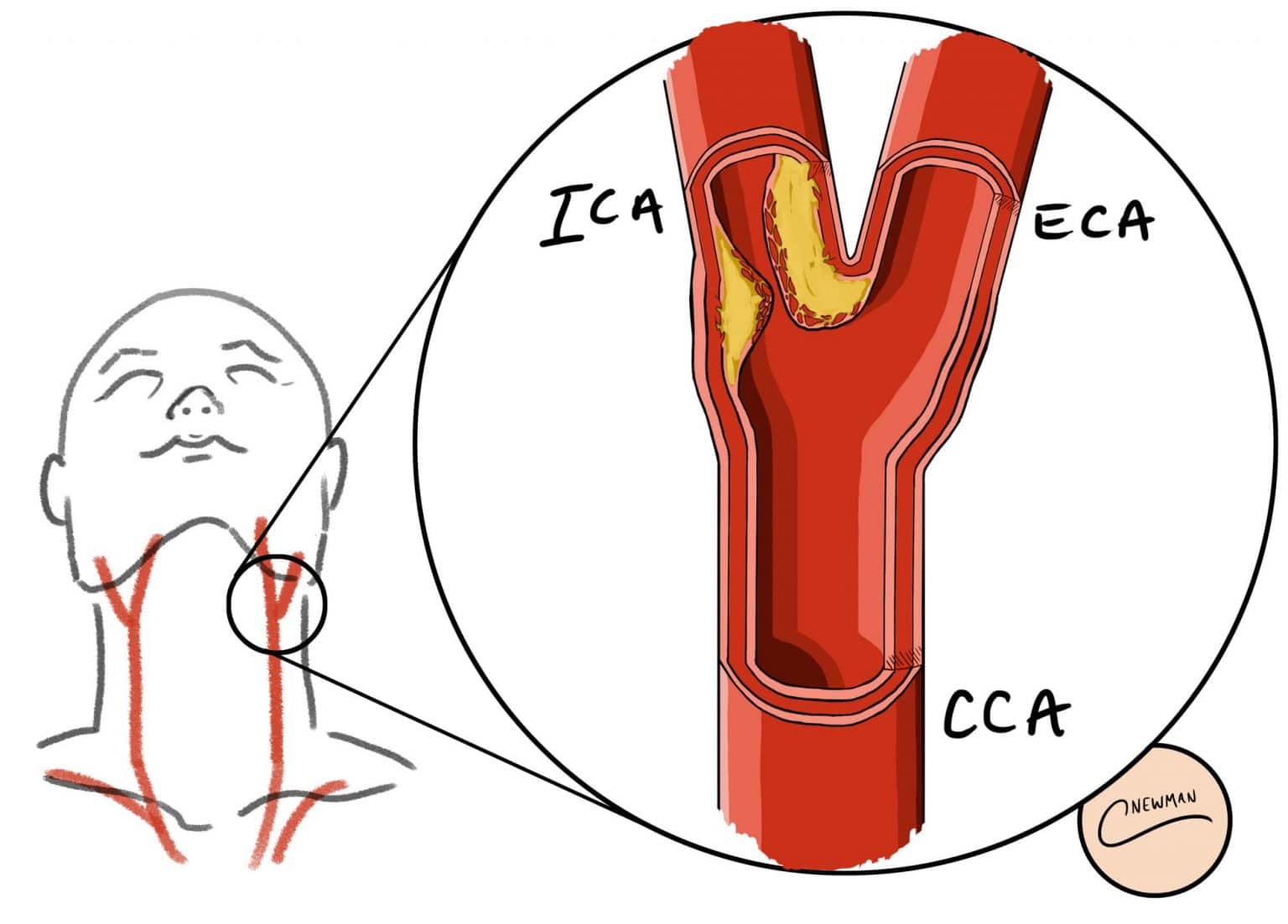 Carotid Artery Disease Clinical Features Management Teachmesurgery 8582