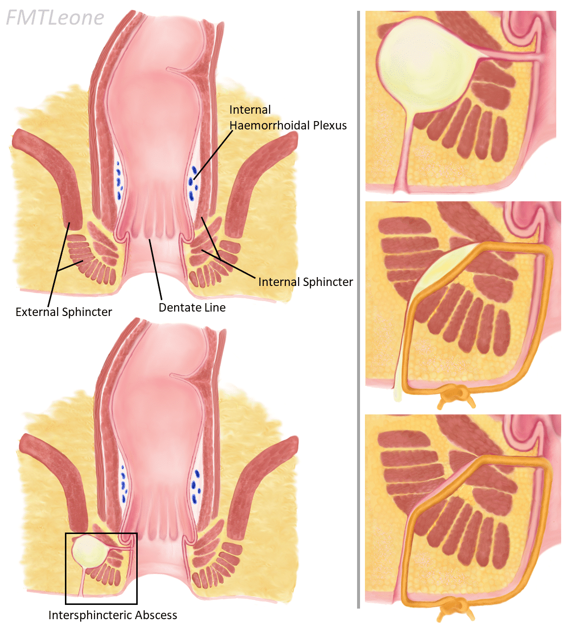 perineal abscess male