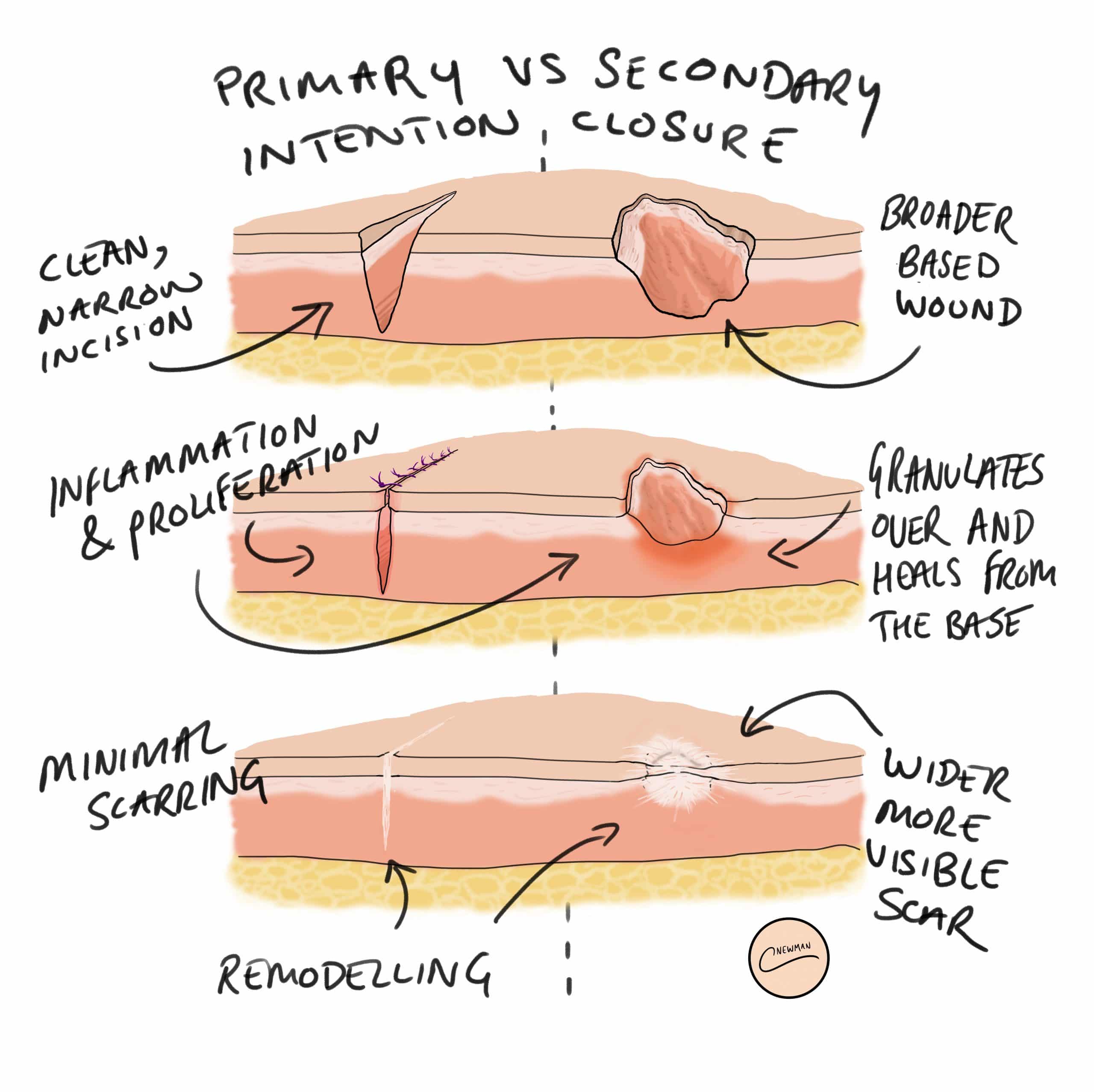 Wound Healing - Primary Intention - Secondary Intention