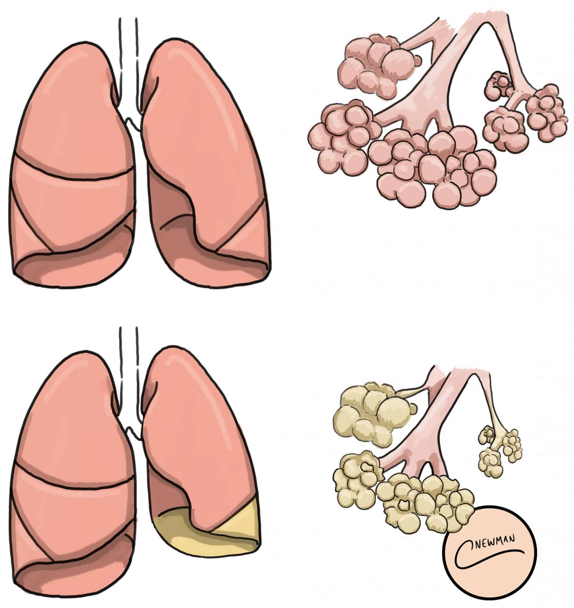 atelectasis lung sounds
