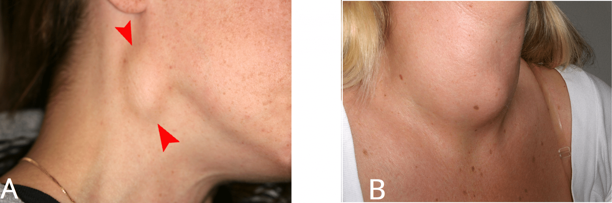 neck-lumps-differential-diagnosis-investigation-teachmesurgery