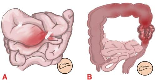 Bowel Obstruction Causes Management TeachMeSurgery