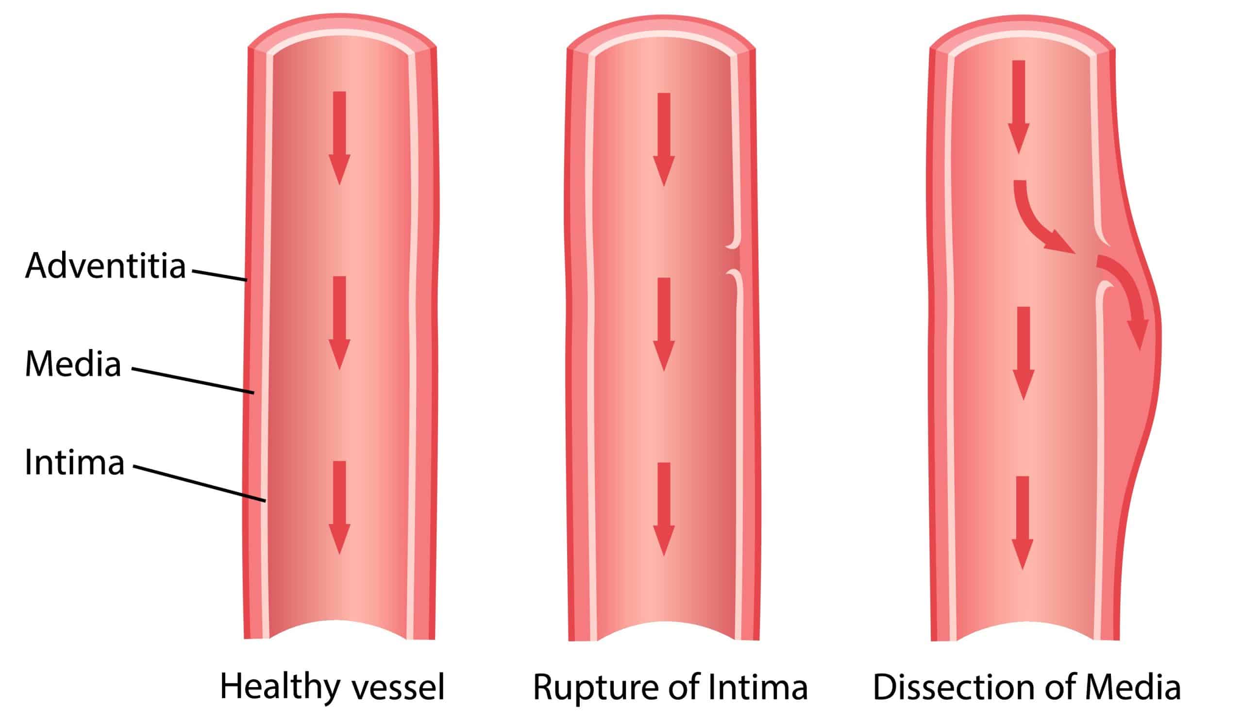 Aortic Dissection Classification Management TeachMeSurgery   Aortic Dissection 