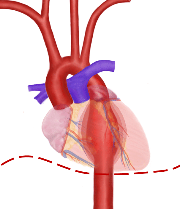 thoracic aortic disruption