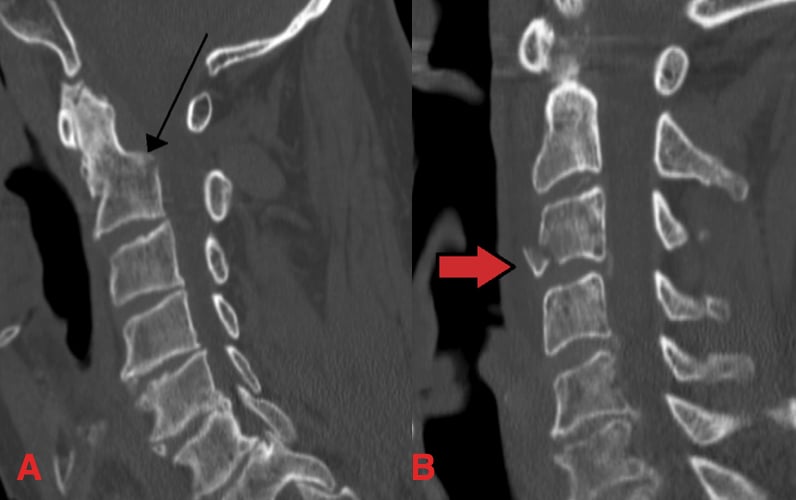 Neck (Cervical Spine) fracture - After Trauma