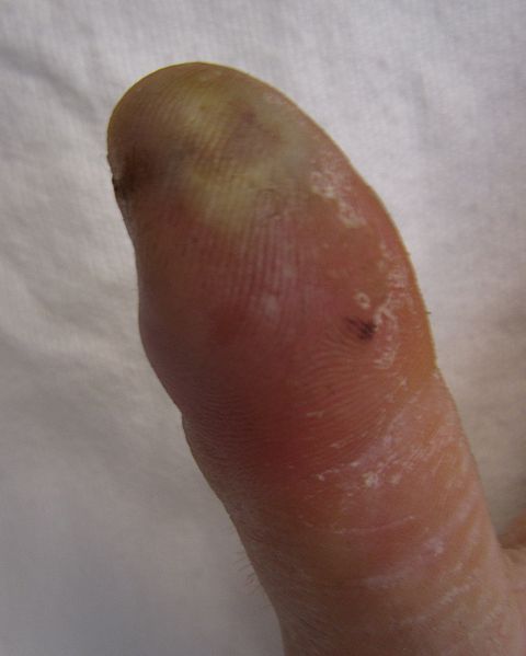 finger infection